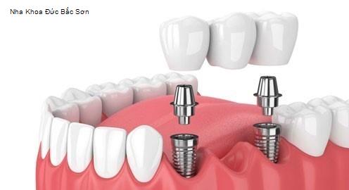 Yến Sào Lạng Sơn - Gợi ý 6 Nha Khoa tốt nhất khu vực Huyện Bắc Sơn
